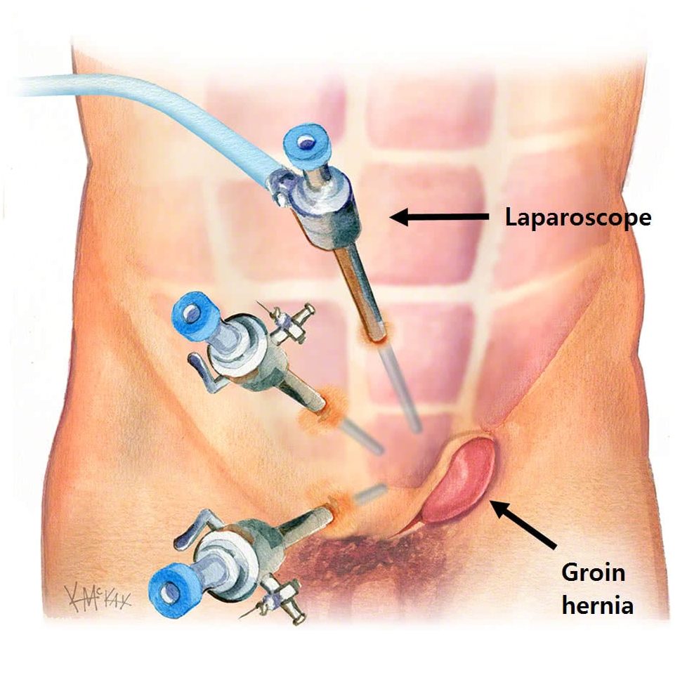 Laparoscopic Hernia Repair