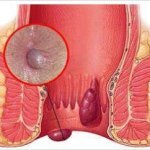 Piles , Fissure, Fistula