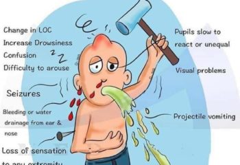 Alarming signs after head injury