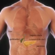 Laparoscopic Cholecystectomy