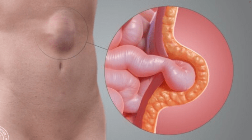 laparoscopic hernia surgery in mumbai