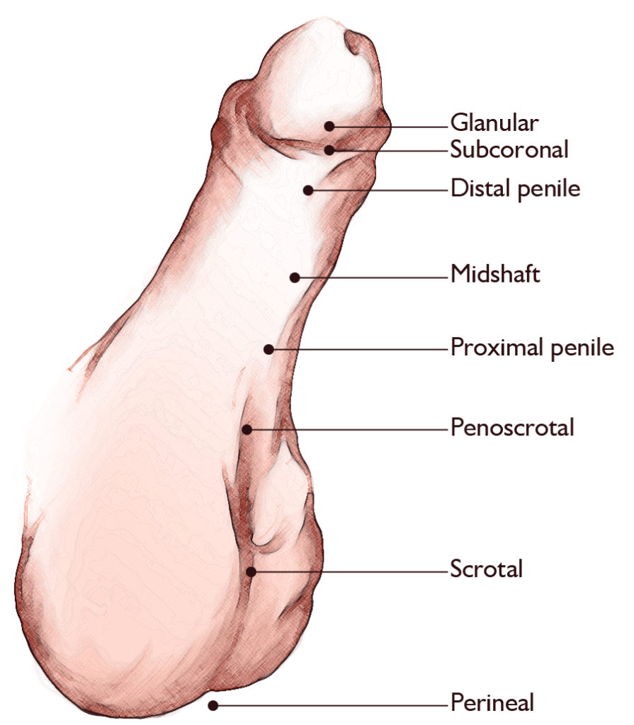 Hypospadias treatment