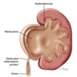 Pelviureteric Junction Obstruction