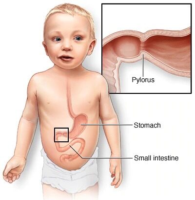 Infantile Hypertrophic Pyloric Stenosis