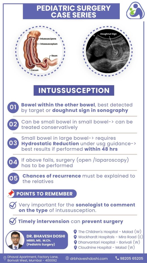 Intussusception PDF Age Range Definition Symptoms 45 OFF