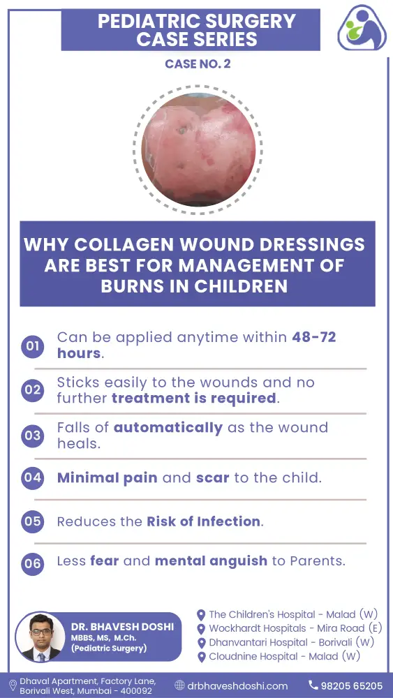 Why Collagen Wound Dressings Are Best For Management Of Burns In Children