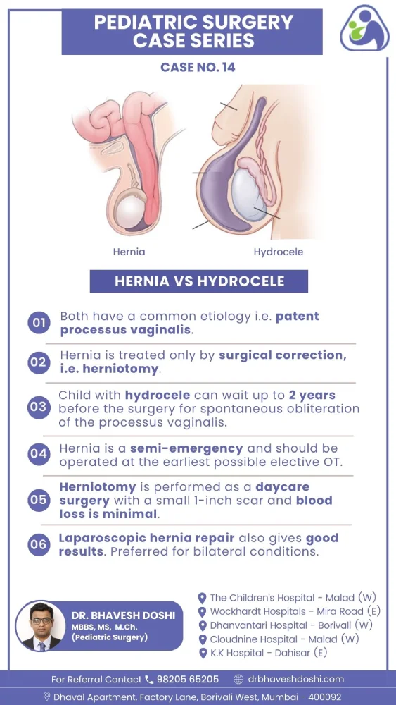 Hernia vs Hydrocele
