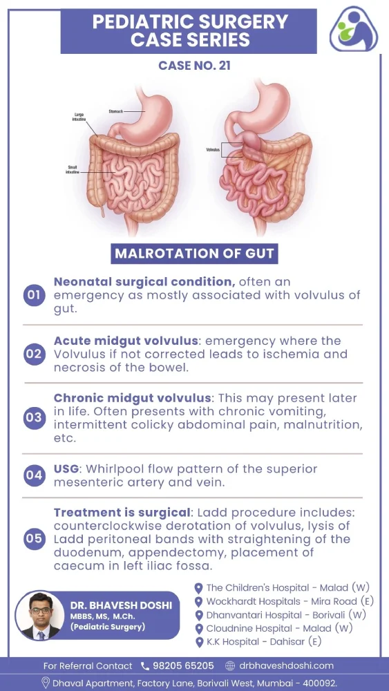 Malrotation of GUT