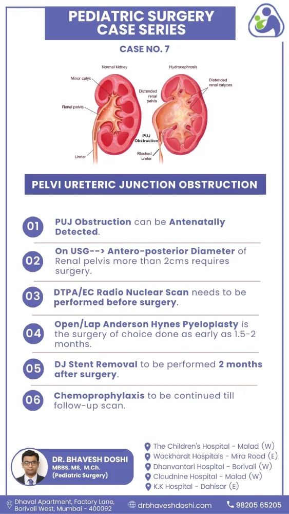 Pelvi Ureteric Junction Obstruction