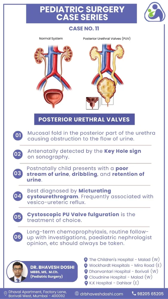 Posterior Urethral Valves