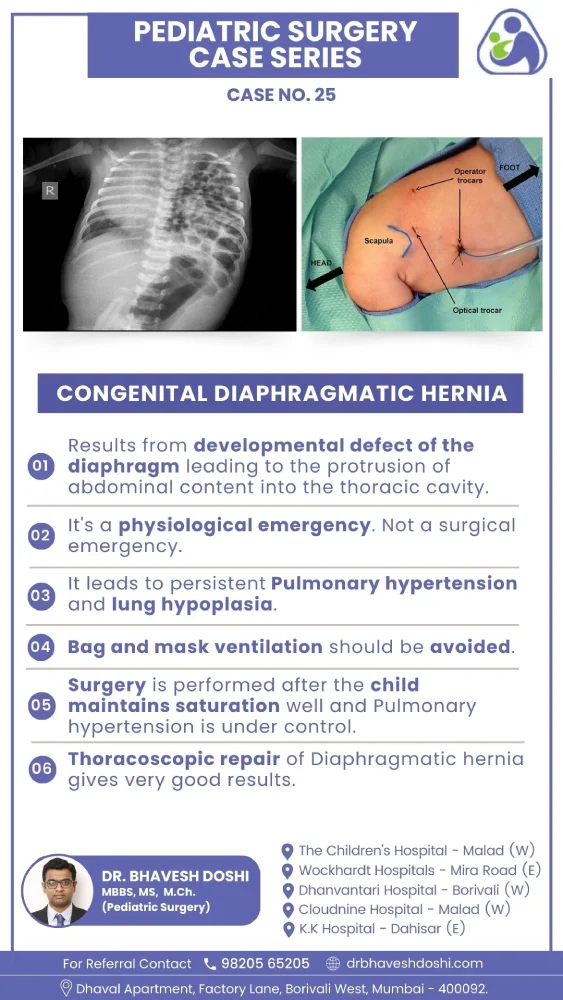 Congenital Diaphragmatic Hernia