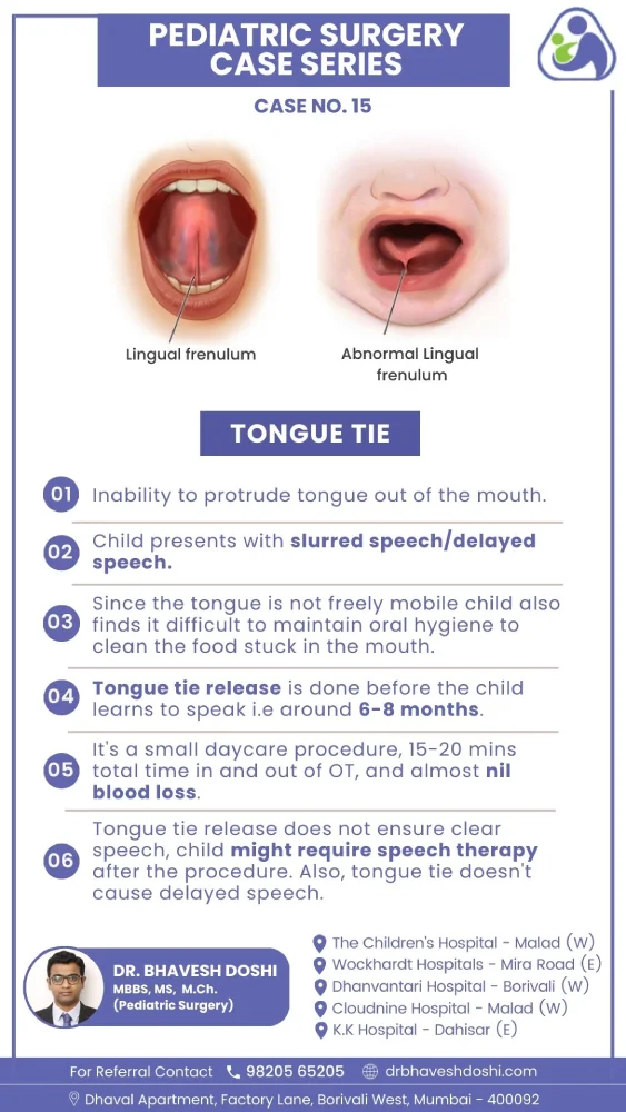 Tongue Tie