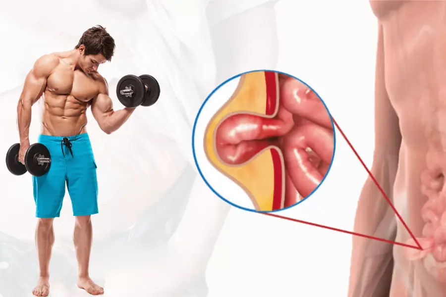 Can I Lift Weights After Hernia Surgery?