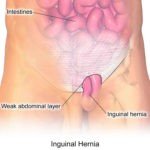 Pediatric Hernia