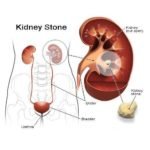 Kidney Stone