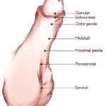 Hypospadias