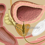 Posterior Urethral Valves